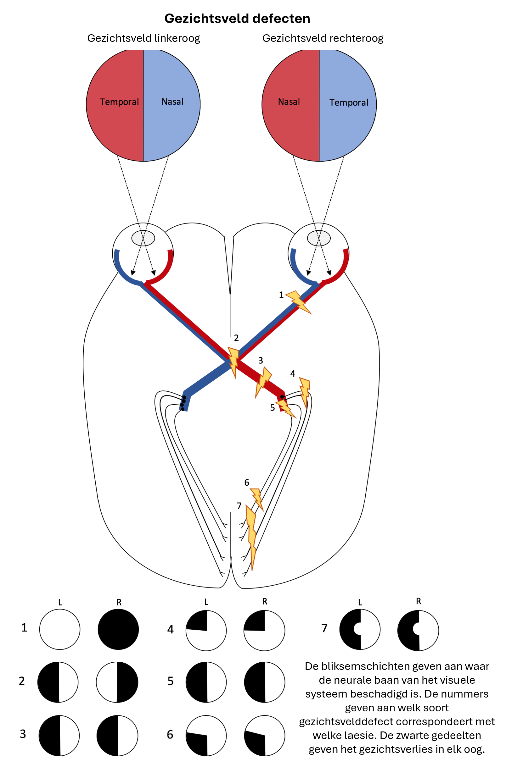Hemianopsie_NL_diagram